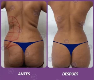 Lipotransferencia 7